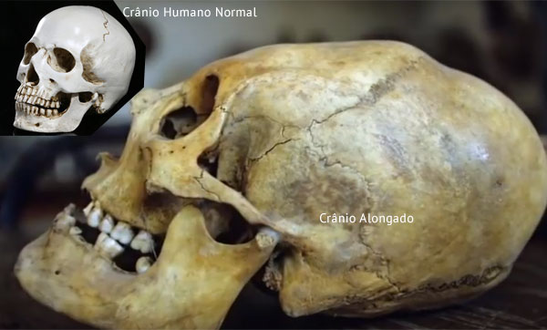 Comparacao cranio humano normal e cabeca alongada