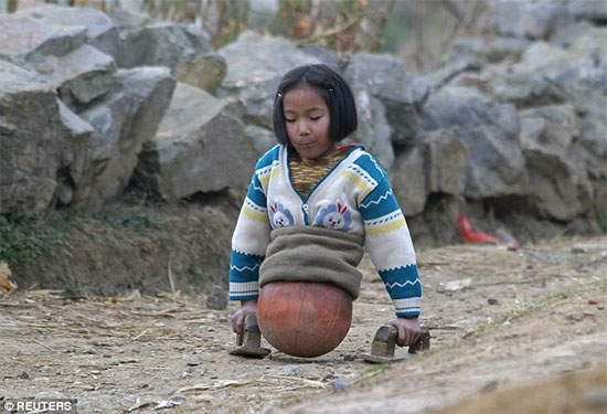 menina chinesa que perdeu suas duas pernas em um trágico acidente e se locomove em cima de uma bola
