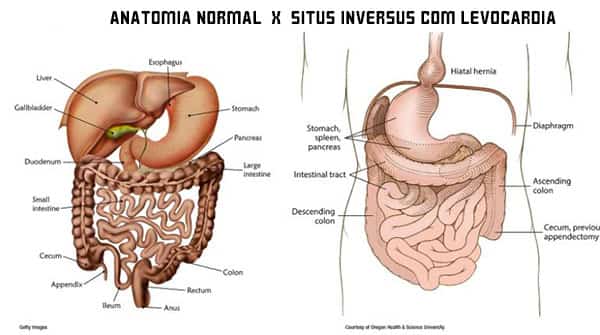 Anatomia normal do corpo x situs inversus com levocardia