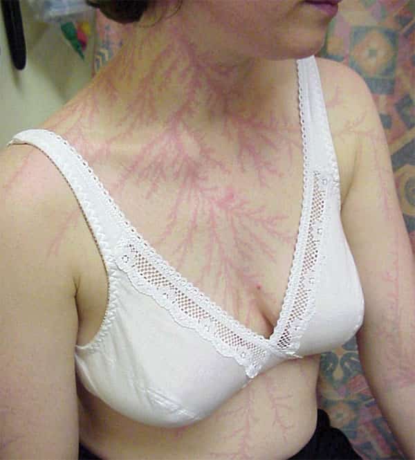 Mulher com cicatriz de raio