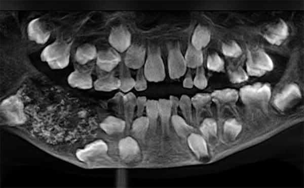 Radiografia dental 526 dentes 