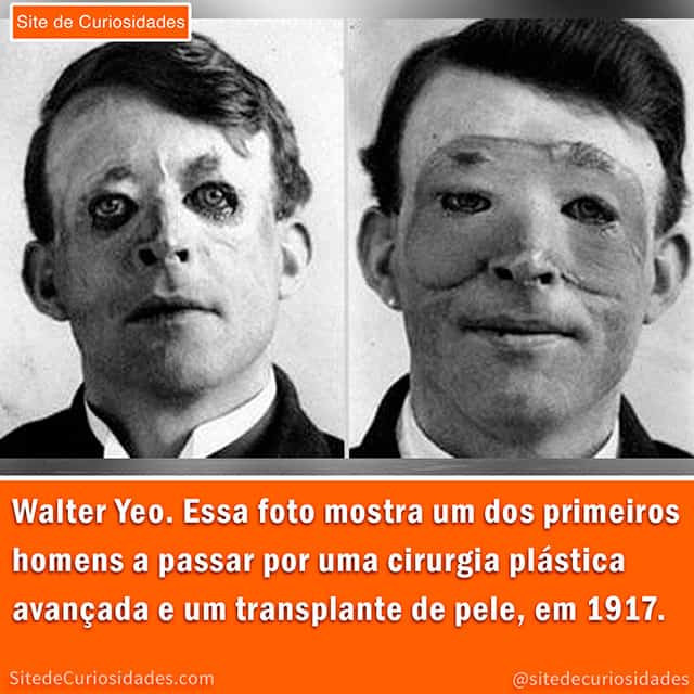 Walter Yeo, cirurgia plastica